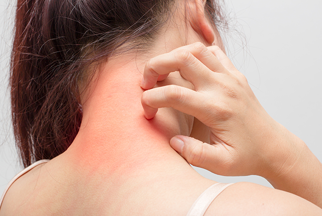 アトピー性皮膚炎にかかった肌の写真